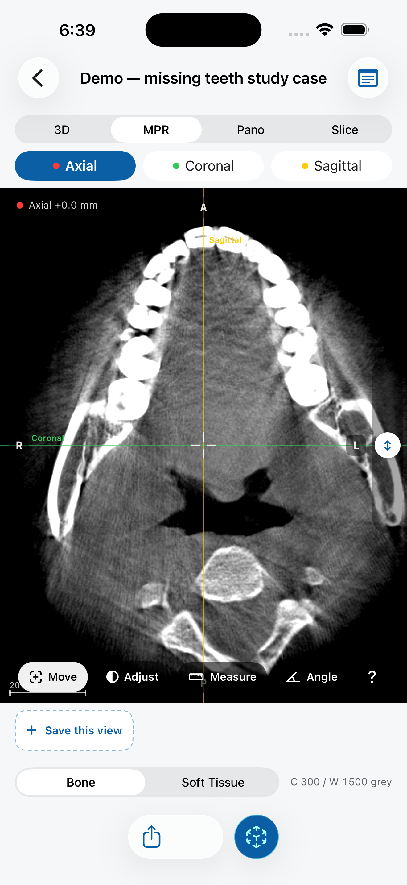 Axial MPR slice with crosshair